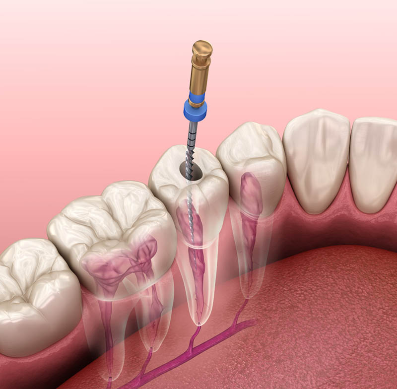 Endodontics (Canal Treatment) ASMED Dental