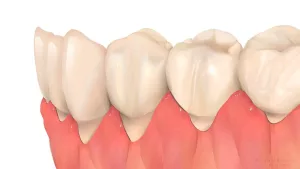 Diş Eti Çekilmesi Nedir?
