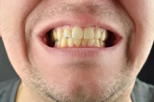 Diş Sararması Nasıl Geçer?